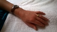Same hand, same day - swelling reduced following one hour session of RLD with me